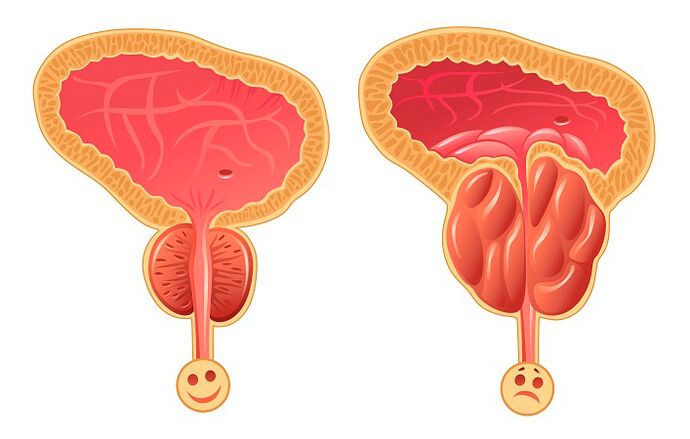 Normalna in vneta prostata