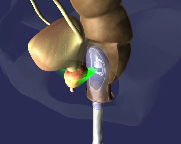 Ultrazvočno zdravljenje prostate za prostatitis