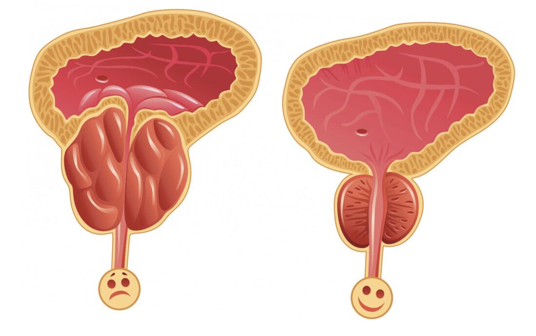 Vnetje prostate s prostatitisom (levo) in prostata je normalna (desno)