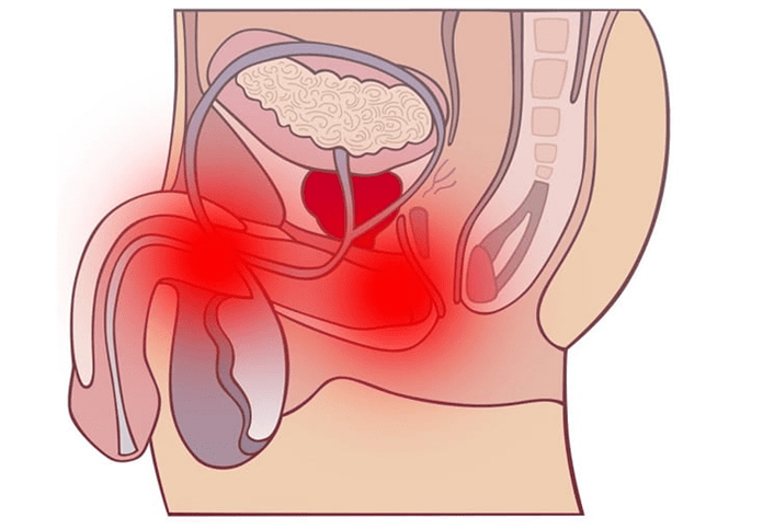 vnetje genitalnega trakta s prostatitisom