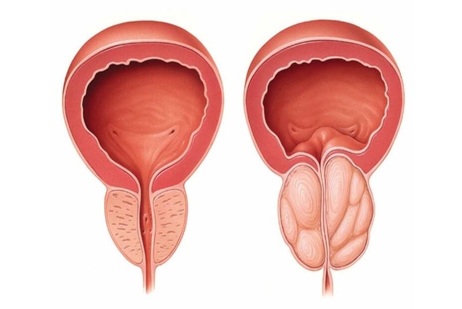 normalna in vneta prostata